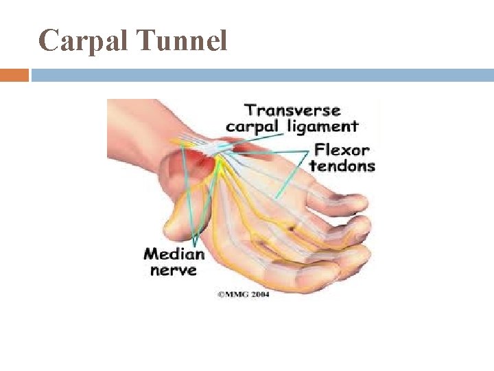 Carpal Tunnel 