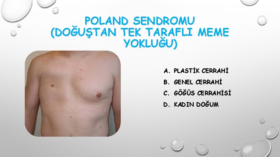 POLAND SENDROMU (DOĞUŞTAN TEK TARAFLI MEME YOKLUĞU) A. PLASTİK CERRAHİ B. GENEL CERRAHİ C.