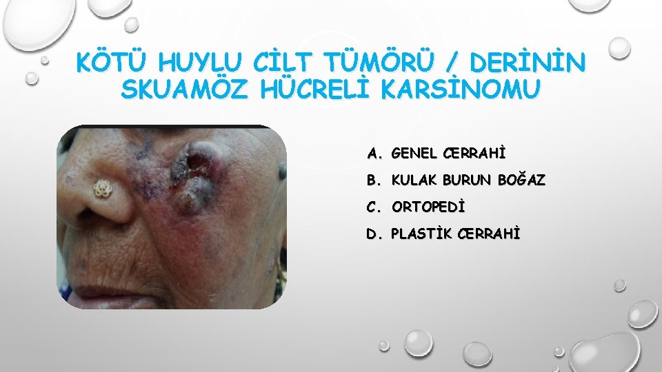 KÖTÜ HUYLU CİLT TÜMÖRÜ / DERİNİN SKUAMÖZ HÜCRELİ KARSİNOMU A. GENEL CERRAHİ B. KULAK