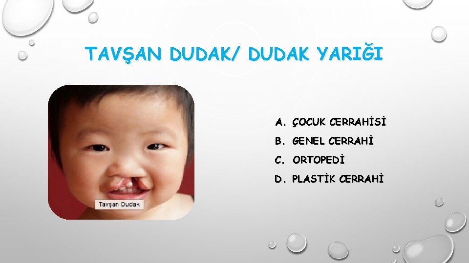 TAVŞAN DUDAK/ DUDAK YARIĞI A. ÇOCUK CERRAHİSİ B. GENEL CERRAHİ C. ORTOPEDİ D. PLASTİK