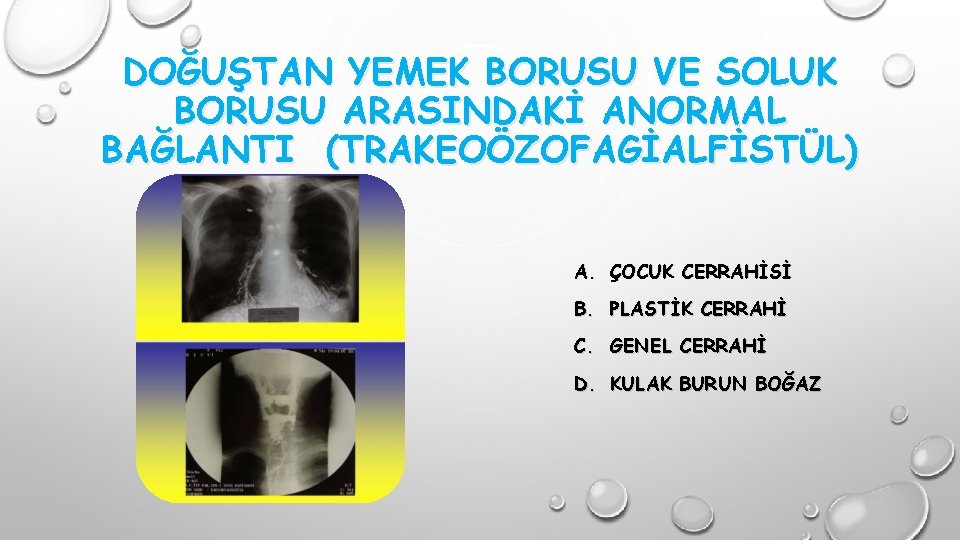 DOĞUŞTAN YEMEK BORUSU VE SOLUK BORUSU ARASINDAKİ ANORMAL BAĞLANTI (TRAKEOÖZOFAGİALFİSTÜL) A. ÇOCUK CERRAHİSİ B.