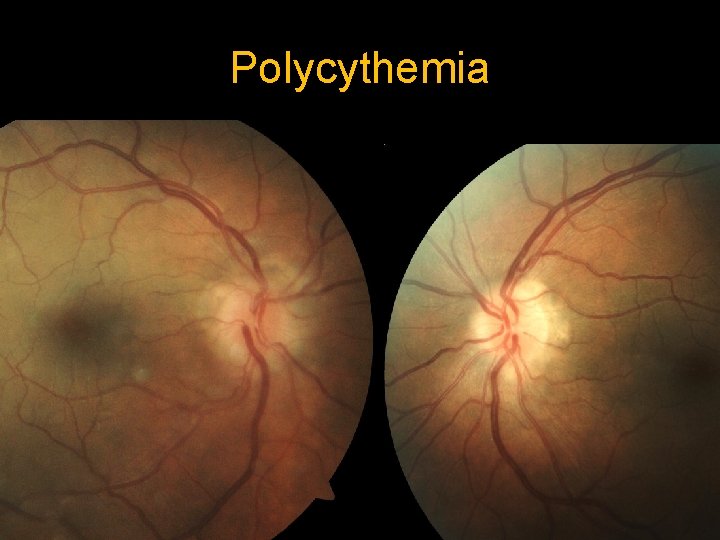 Polycythemia 