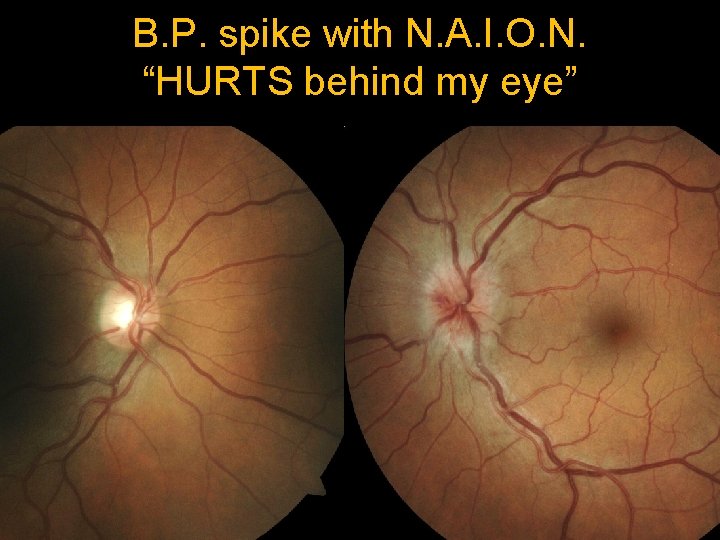 B. P. spike with N. A. I. O. N. “HURTS behind my eye” 