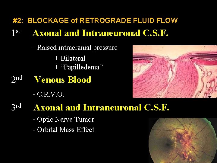 #2: BLOCKAGE of RETROGRADE FLUID FLOW 1 st Axonal and Intraneuronal C. S. F.