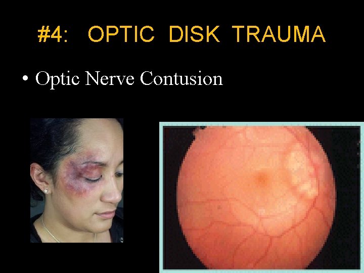 #4: OPTIC DISK TRAUMA • Optic Nerve Contusion 