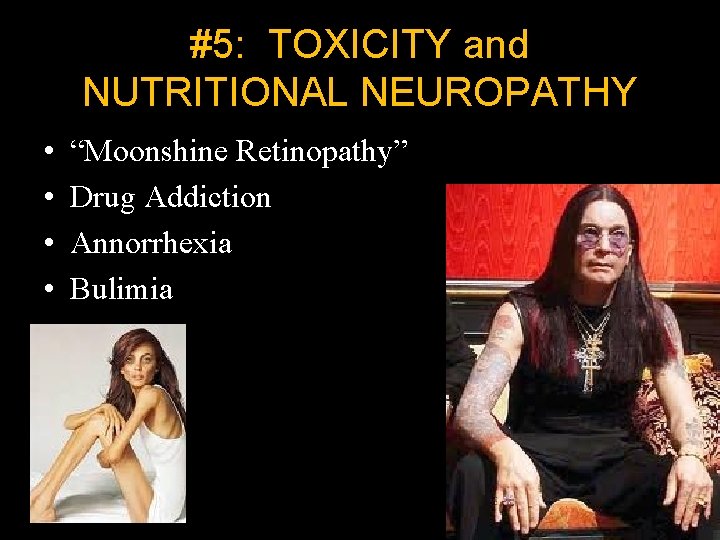 #5: TOXICITY and NUTRITIONAL NEUROPATHY • • “Moonshine Retinopathy” Drug Addiction Annorrhexia Bulimia 