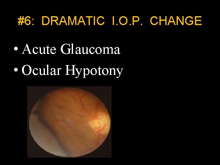 #6: DRAMATIC I. O. P. CHANGE • Acute Glaucoma • Ocular Hypotony 