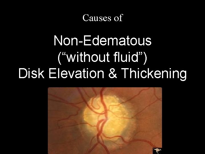 Causes of Non-Edematous (“without fluid”) Disk Elevation & Thickening 