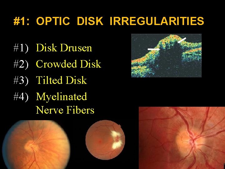 #1: OPTIC DISK IRREGULARITIES #1) #2) #3) #4) Disk Drusen Crowded Disk Tilted Disk