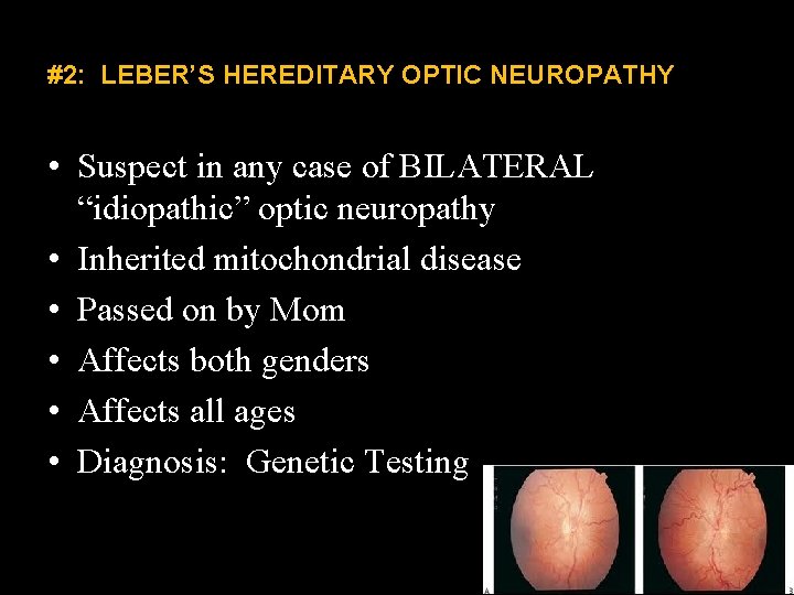 #2: LEBER’S HEREDITARY OPTIC NEUROPATHY • Suspect in any case of BILATERAL “idiopathic” optic