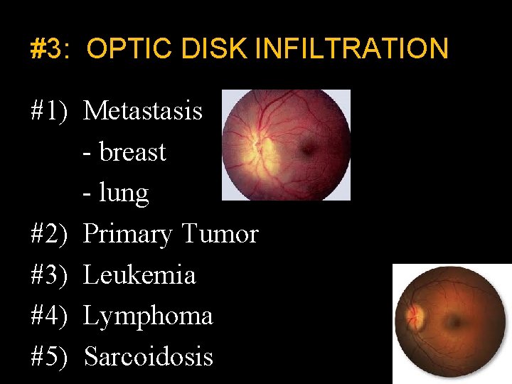 #3: OPTIC DISK INFILTRATION #1) Metastasis - breast - lung #2) Primary Tumor #3)
