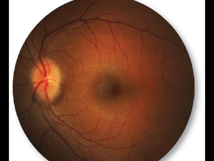 Retinal Folds? 