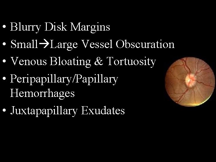  • • Blurry Disk Margins Small Large Vessel Obscuration Venous Bloating & Tortuosity