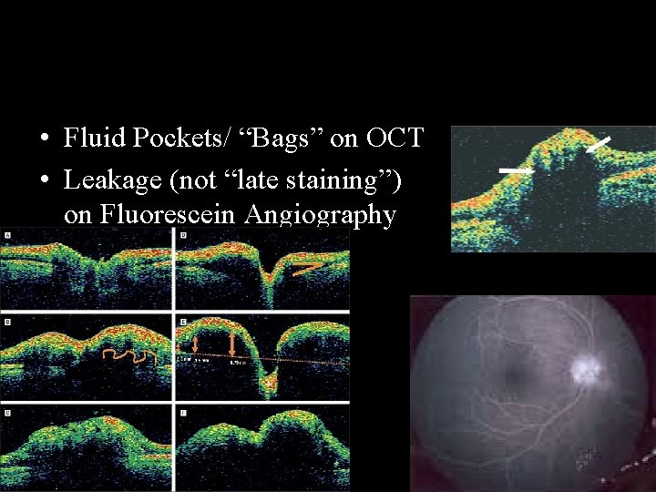  • Fluid Pockets/ “Bags” on OCT • Leakage (not “late staining”) on Fluorescein