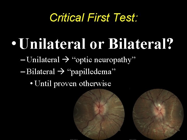 Critical First Test: • Unilateral or Bilateral? – Unilateral “optic neuropathy” – Bilateral “papilledema”
