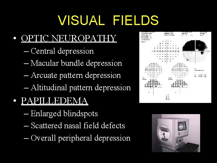 VISUAL FIELDS • OPTIC NEUROPATHY – Central depression – Macular bundle depression – Arcuate