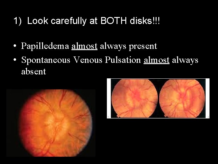 1) Look carefully at BOTH disks!!! • Papilledema almost always present • Spontaneous Venous