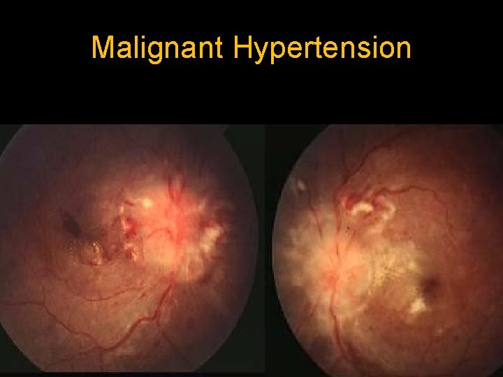Malignant Hypertension 