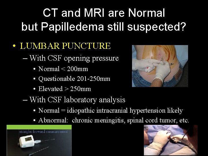 CT and MRI are Normal but Papilledema still suspected? • LUMBAR PUNCTURE – With