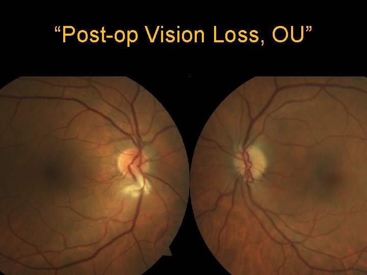 “Post-op Vision Loss, OU” 