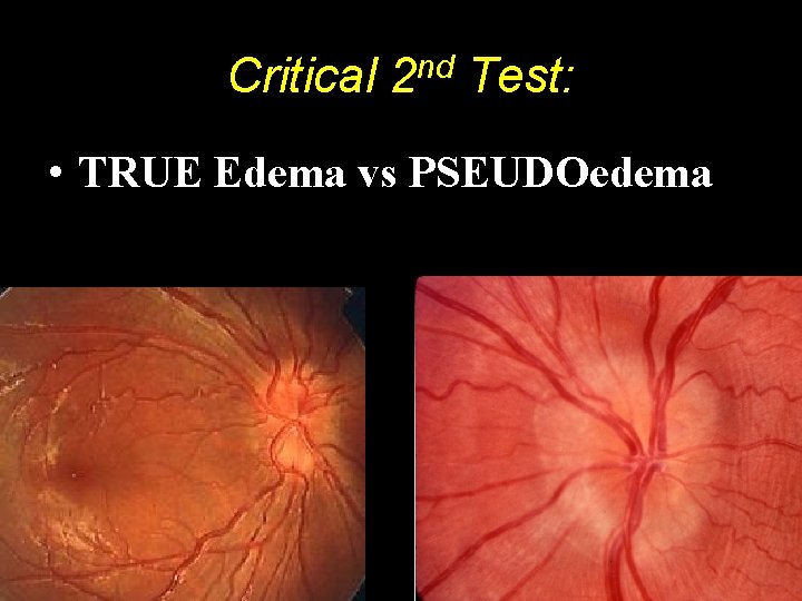 Critical 2 nd Test: • TRUE Edema vs PSEUDOedema 