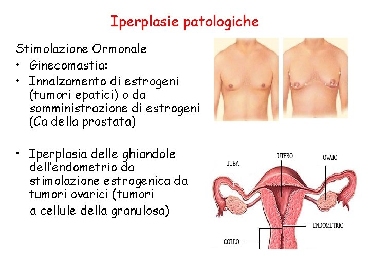 Iperplasie patologiche Stimolazione Ormonale • Ginecomastia: • Innalzamento di estrogeni (tumori epatici) o da