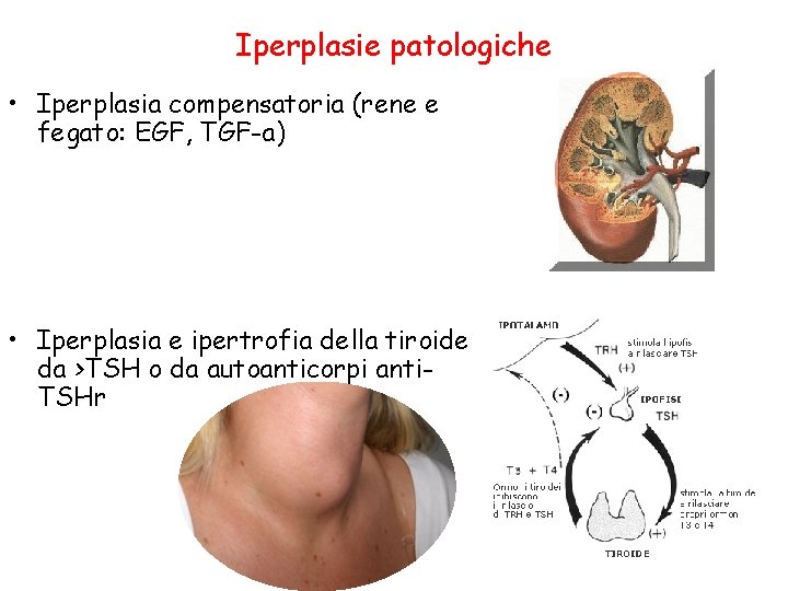 Iperplasie patologiche • Iperplasia compensatoria (rene e fegato: EGF, TGF-a) • Iperplasia e ipertrofia