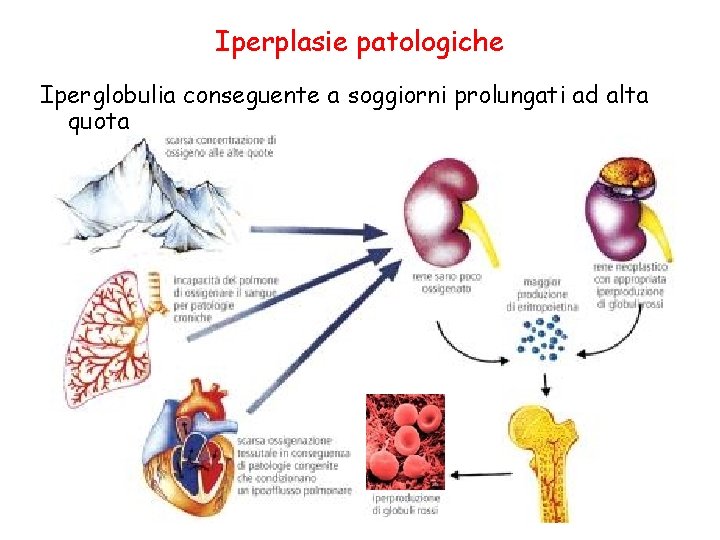 Iperplasie patologiche Iperglobulia conseguente a soggiorni prolungati ad alta quota Iperplasie patologiche Iperglobulia conseguente a soggiorni prolungati ad alta quota