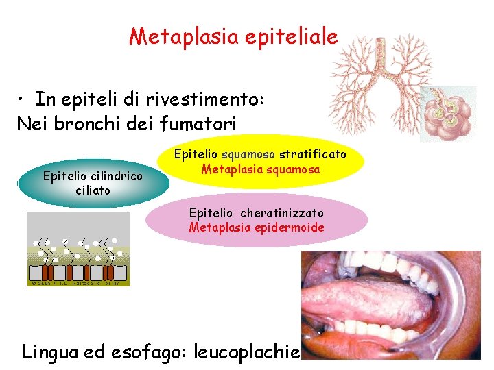 Metaplasia epiteliale • In epiteli di rivestimento: Nei bronchi dei fumatori Epitelio cilindrico ciliato