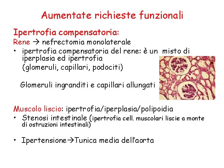 Aumentate richieste funzionali Ipertrofia compensatoria: Rene nefrectomia monolaterale • ipertrofia compensatoria del rene: è