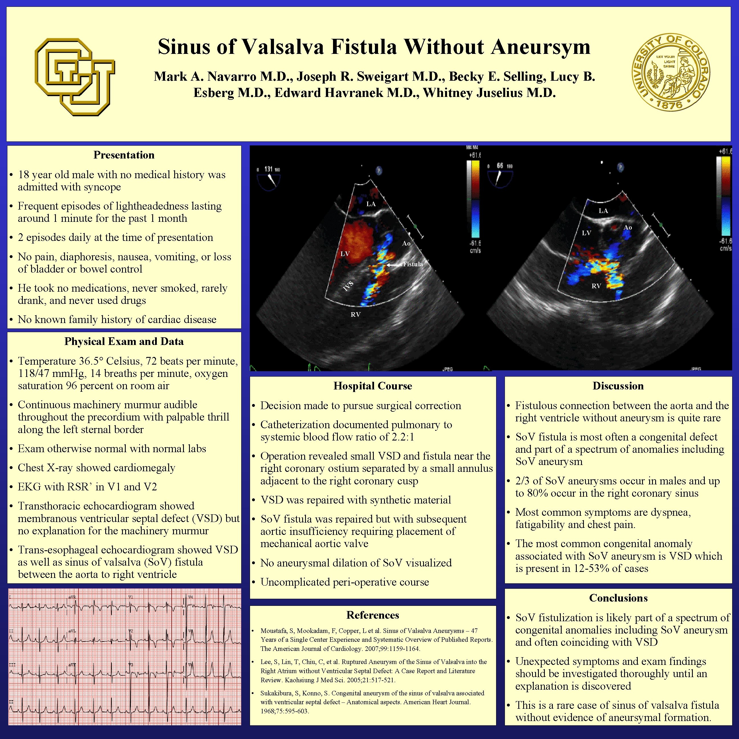 Sinus of Valsalva Fistula Without Aneursym Mark A. Navarro M. D. , Joseph R.