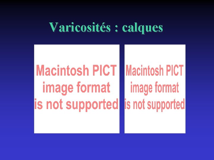 Varicosités : calques 