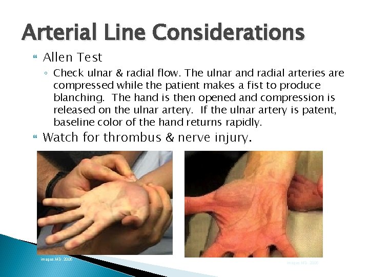 Arterial Line Considerations Allen Test ◦ Check ulnar & radial flow. The ulnar and