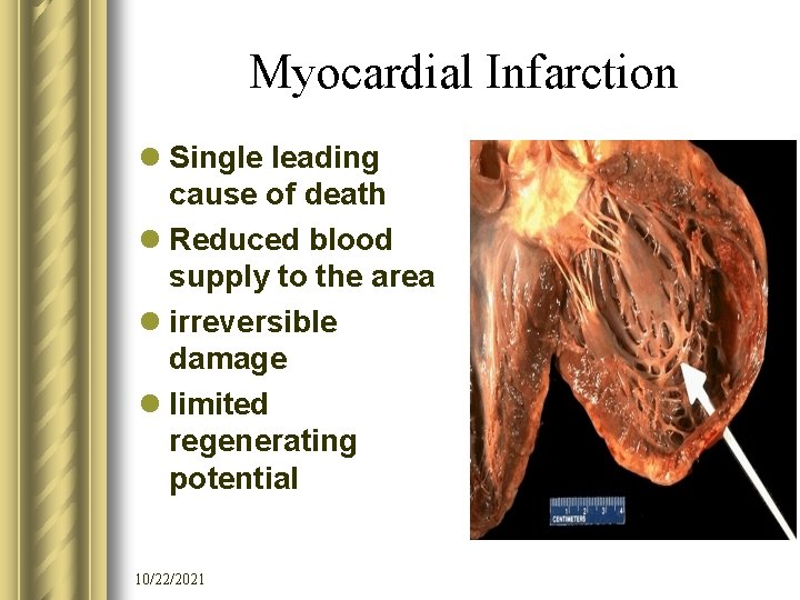 Myocardial Infarction l Single leading cause of death l Reduced blood supply to the