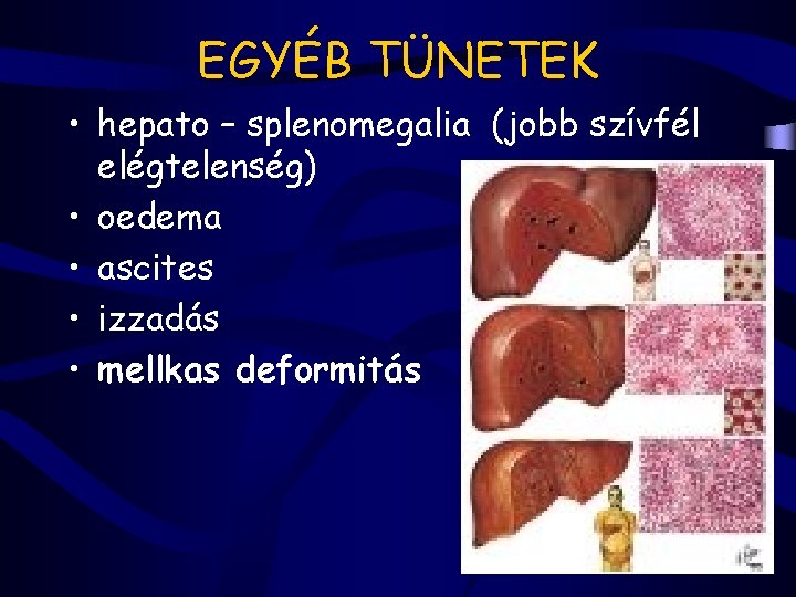 EGYÉB TÜNETEK • hepato – splenomegalia (jobb szívfél elégtelenség) • oedema • ascites •