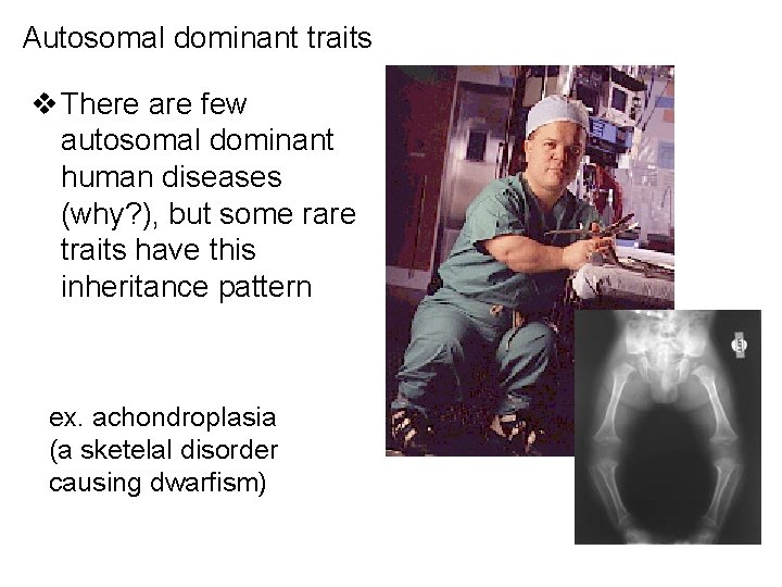 Autosomal dominant traits v There are few autosomal dominant human diseases (why? ), but