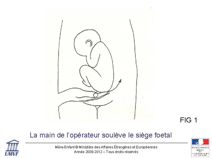 Figure 1 FIG 1 La main de l’opérateur soulève le siège foetal Mère-Enfant ©