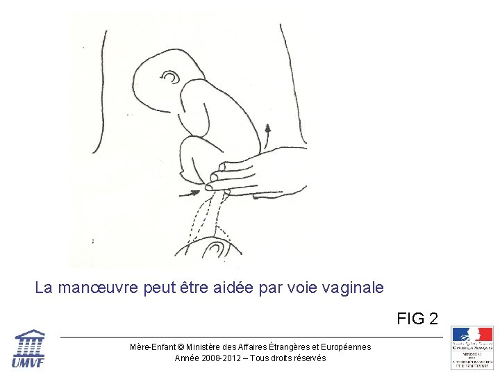 Figure 2 La manœuvre peut être aidée par voie vaginale FIG 2 Mère-Enfant ©
