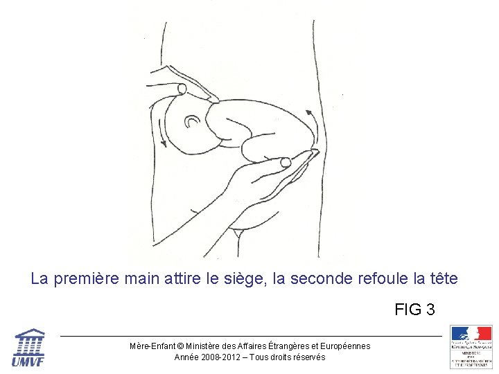Figure 3 La première main attire le siège, la seconde refoule la tête FIG