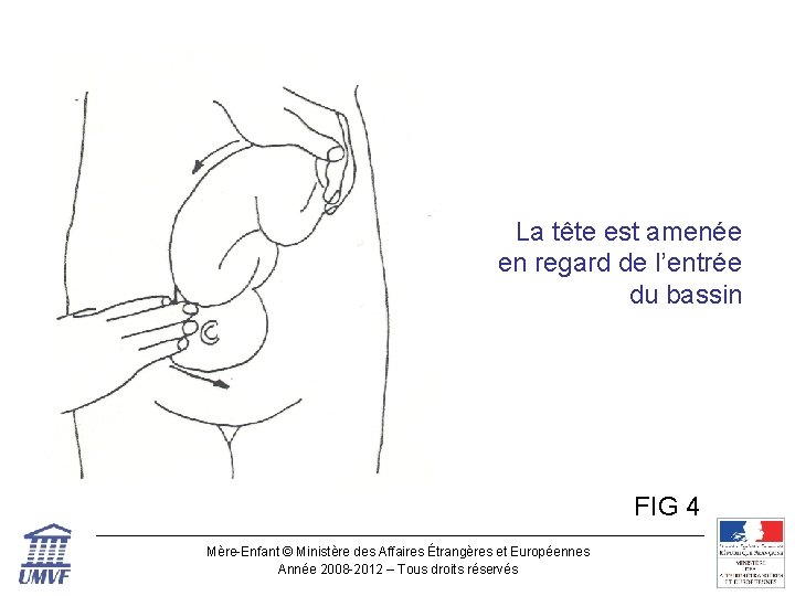 Figure 4 La tête est amenée en regard de l’entrée du bassin FIG 4