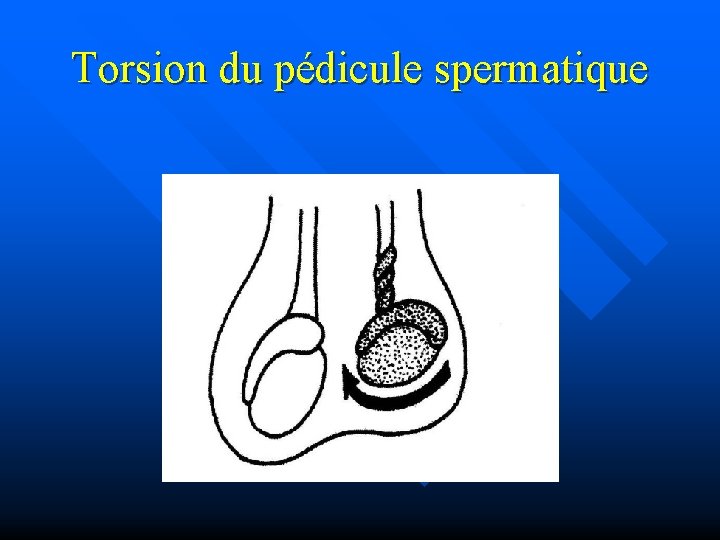 Torsion du pédicule spermatique 