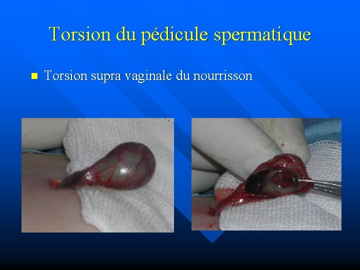 Torsion du pédicule spermatique n Torsion supra vaginale du nourrisson 