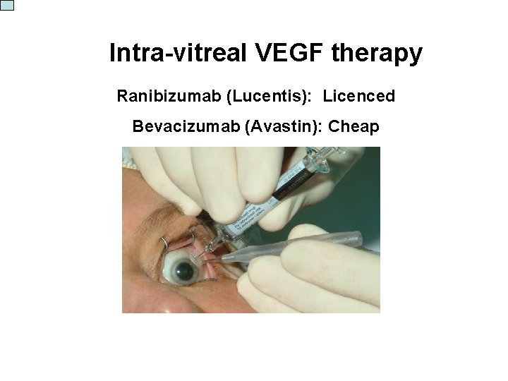 Intra-vitreal VEGF therapy Ranibizumab (Lucentis): Licenced Bevacizumab (Avastin): Cheap 