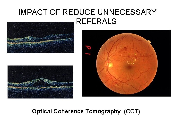 IMPACT OF REDUCE UNNECESSARY REFERALS Optical Coherence Tomography (OCT) 