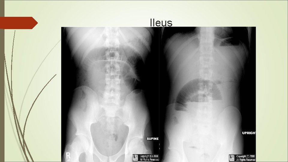 Ileus 