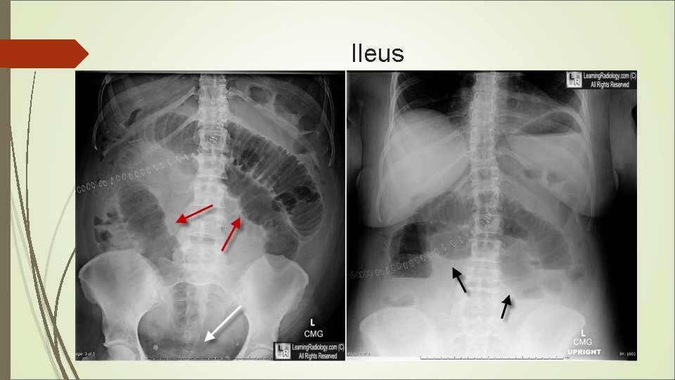 Ileus 