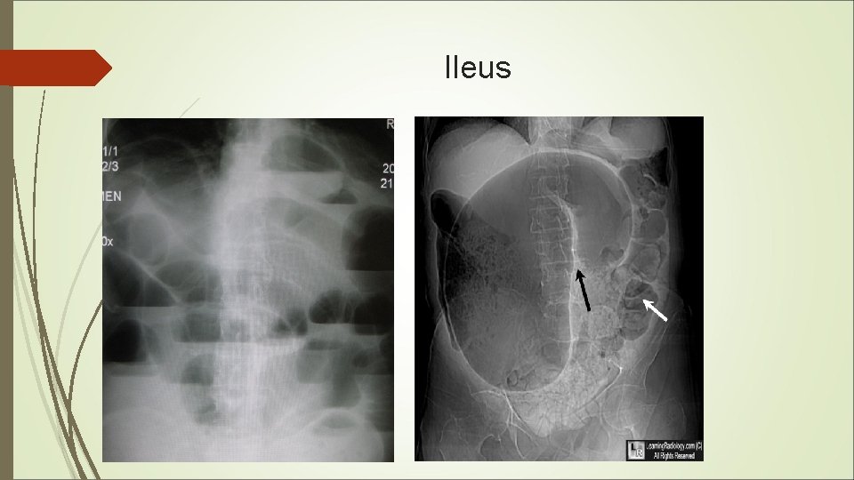 Ileus 