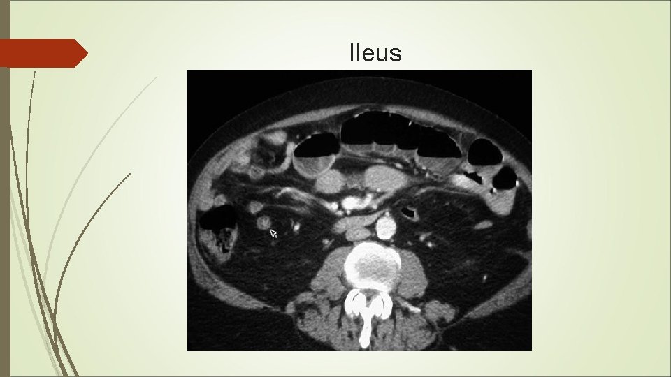 Ileus 