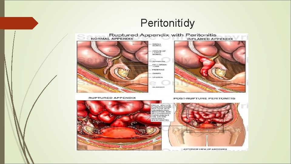 Peritonitídy 