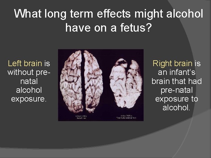 What long term effects might alcohol have on a fetus? Left brain is without